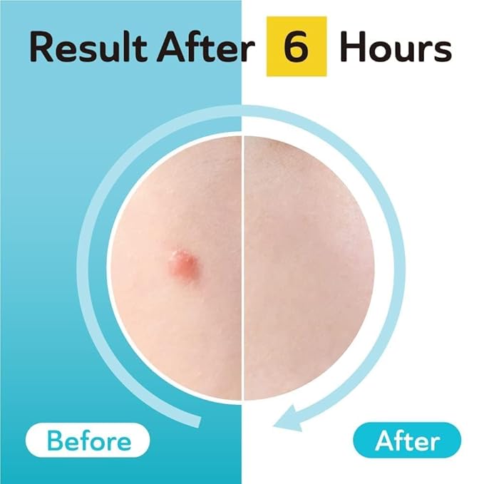 DERMA ANGEL Dark Spot Patches Blemish Patches with Hydrocolloid, TXA & CICA for Active Acne & Post-Inflammatory Dark Spots - Day and Night Use - UPGRADED (Post Acne - 132 Count - 2 Size)